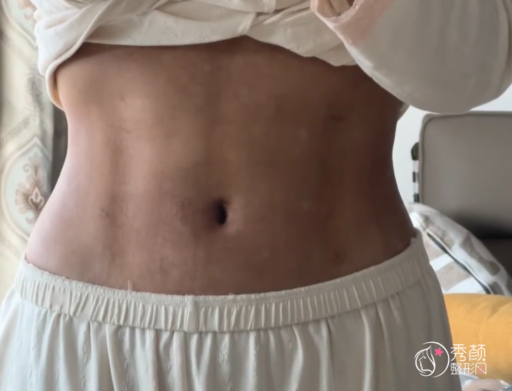 上海吸脂医生排名：江华、谢芸、皮庆猛、蒋华等医生实力上榜