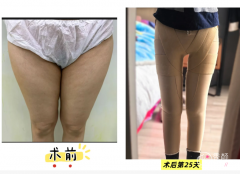 北京吸脂医生排名