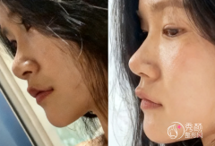 深圳鼻修复医生排名：于丽、崔永言、刘冰、汪道新等医生实力上榜