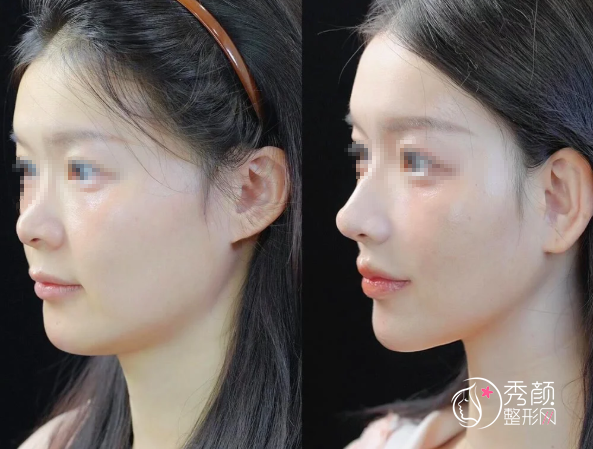 南京鼻修复医生排名：吴杰、宁官森、曹海峰、冯思阳等医生实力上榜