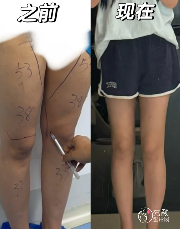 武汉吸脂医生排名：吴闯、王松山、黄磊、付毅等实力医生上榜