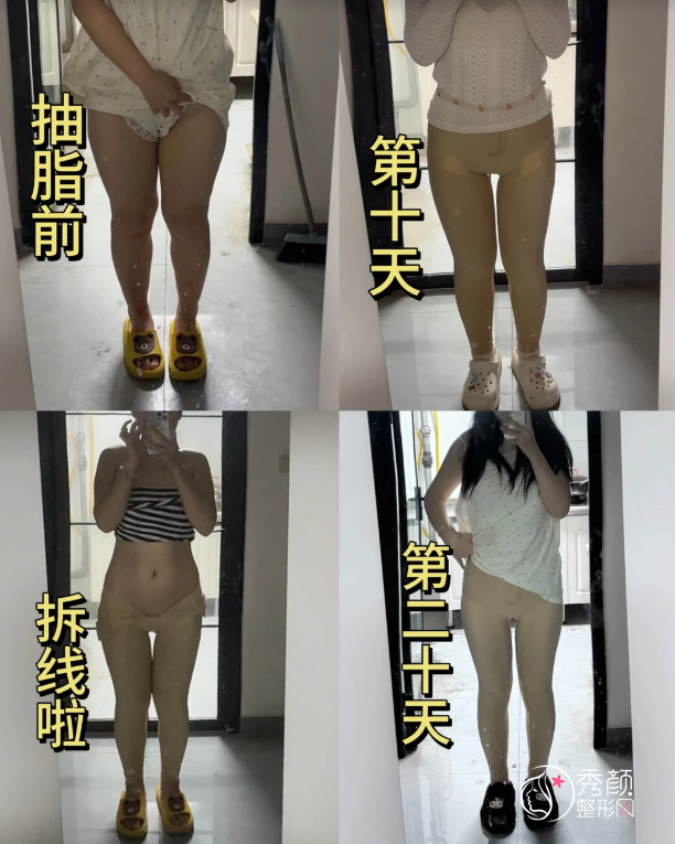 深圳吸脂医生排名：庄礼大、杨卫国、黄海侠、曹孟君等实力医生上榜