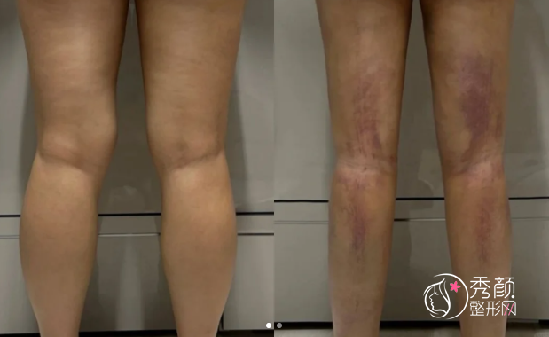 广州吸脂医生排名：赵成利、鲁峰、王世虎、王洪勇等实力医生上榜