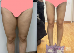 成都吸脂医生排名：李正勇、游晓波、蒲小兵等实力医生上榜