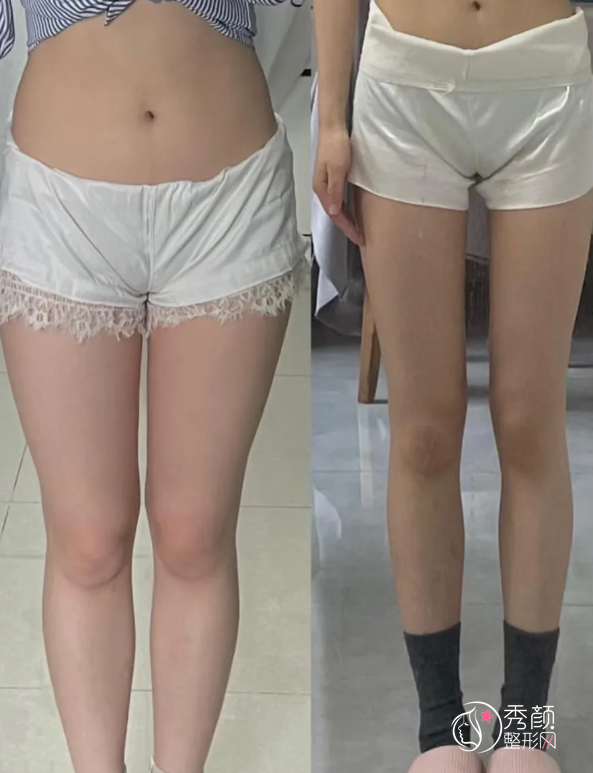 青岛吸脂医生排名：陈振雨、袁家德、曹继武等医生实力上榜