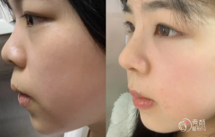 重庆隆鼻医生排名：张家平、果磊、刘健等医生实力上榜