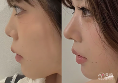 济南隆鼻医生排名：张健、逄宝峰、罗晋等医生实力上榜