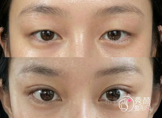 广州双眼皮医生排名：李光琴、陈贵宗、范丹等医生实力上榜