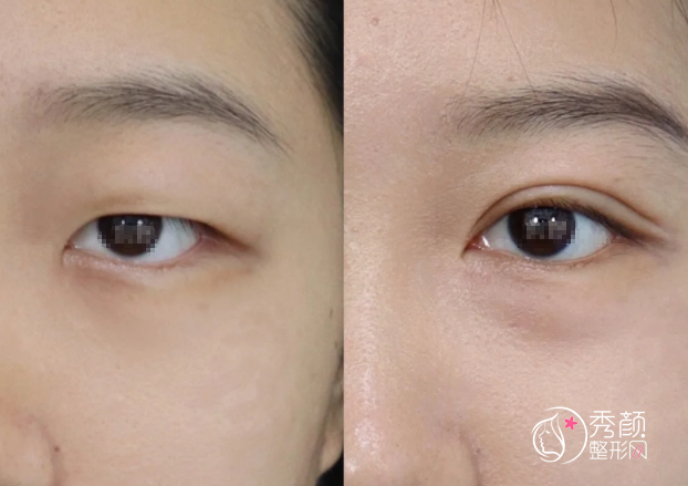 杭州双眼皮医生排名：徐丹、盛飞、刘中策等医生实力上榜