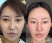 广州拉皮医生排名