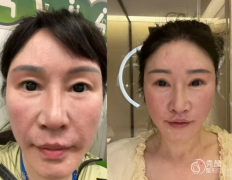 南京拉皮医生排名