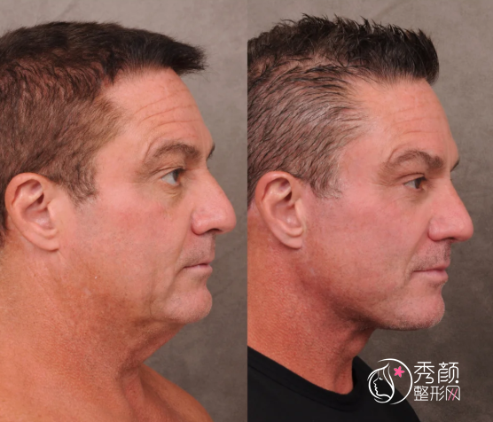 成都拉皮医生排名：李建钢、刘黎明、潘成等医生实力上榜