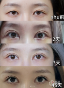 北京双眼皮医生排名：魏志香、张冰洁、师丽丽等医生实力上榜