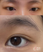 上海双眼皮医生排名：邢书亮、黄筱琳、朱迪等医生实力上榜