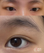 重庆双眼皮医生排