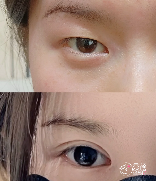 济南双眼皮医生排名：韩旭、谢燕燕、王召东等实力医生上榜