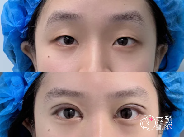 青岛双眼皮医生排名：马昕、姜留刚、孙好杰等医生实力上榜