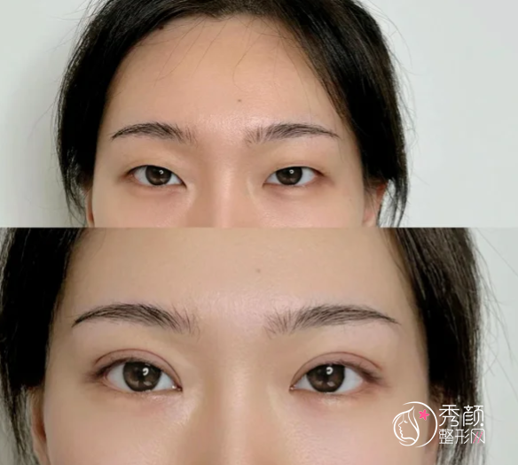 长沙双眼皮医生排名：龙剑虹、张姣姣、解灿等医生实力上榜