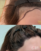 长沙植发医生排名：彭聪、方柏荣、彭海涛等医生实力上榜