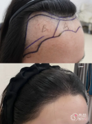 南京植发医生排名：李诚让、尹志强、张亮等医生实力上榜