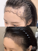 深圳植发医生排名：文亚雄、常曦东、栾宏刚等医生实力上榜