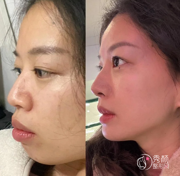 上海玻尿酸注射医生推荐：孙璧乔、郭敬松、黄晔文、张炜等口碑好！