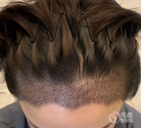 广州植发医生排名