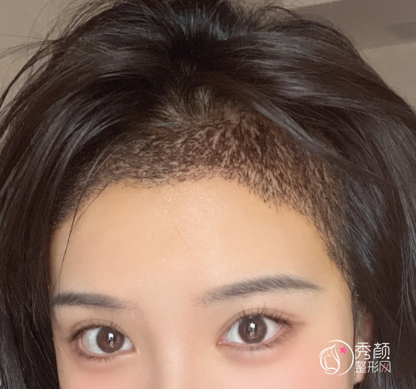 成都植发医生排名：梁峰、林民源、王亮等医生实力上榜