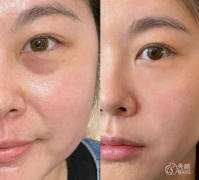 武汉玻尿酸注射医生排名：黄文鸿、陈耀文、祝栋等医生实力上榜