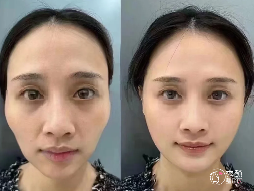 深圳玻尿酸注射医生排名：富娜、何花、陈瑞红等医生实力上榜