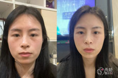 杭州玻尿酸注射医生排名：李俊霞、戴柳丽、柳兆峰等医生实力上榜