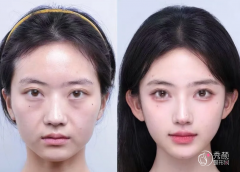 上海玻尿酸注射医生排名：李花停、郭敬松、聂婕等医生实力上榜