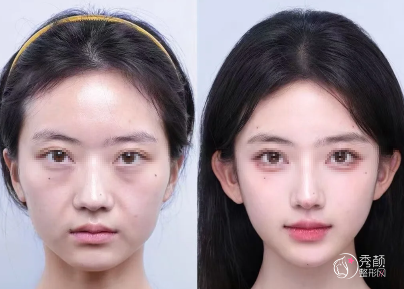 上海玻尿酸注射医生排名：李花停、郭敬松、聂婕等医生实力上榜