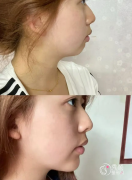 北京玻尿酸注射医生排名：谷亦涵、霍登轮、陈媛等医生实力上榜