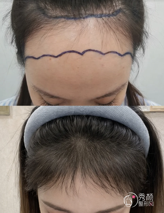 重庆植发医生排名：毛作源、尹笃、欧福泉等医生实力上榜