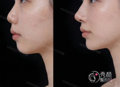 青岛玻尿酸注射医生排名：杨永胜、林建新、杨潇等医生实力上榜