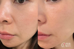 长沙玻尿酸注射医生排名：吴姗姗、李钞、刘莫靖子等医生实力上榜