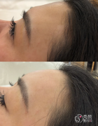 重庆玻尿酸注射医生排名：潘宝华、朱芯、刘兴灵等医生实力上榜