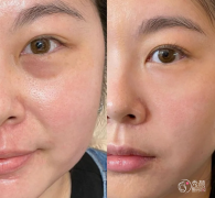 济南玻尿酸注射医生排名：王苹、张永琳、陈朋等医生实力上榜