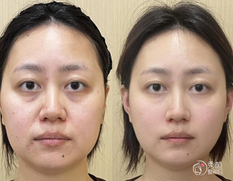 长沙童颜针认证医生排名：肖锋、袁妍妍、聂桥林等医生实力上榜