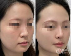 深圳童颜针认证医