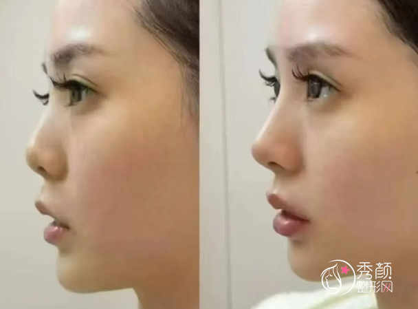 杭州鼻综合医生排名：徐利刚、李保锴、刘中策等医生实力上榜