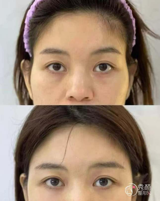 杭州自体脂肪丰面颊医生排名：翟爽、郑翔宇、马腾等医生实力上榜