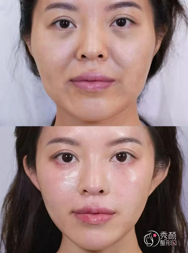 成都自体脂肪丰面颊医生排名：王家勇、王亚璐、罗通贵等医生实力上榜