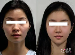 上海自体脂肪丰面