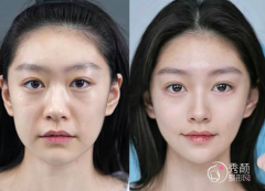 北京自体脂肪丰面