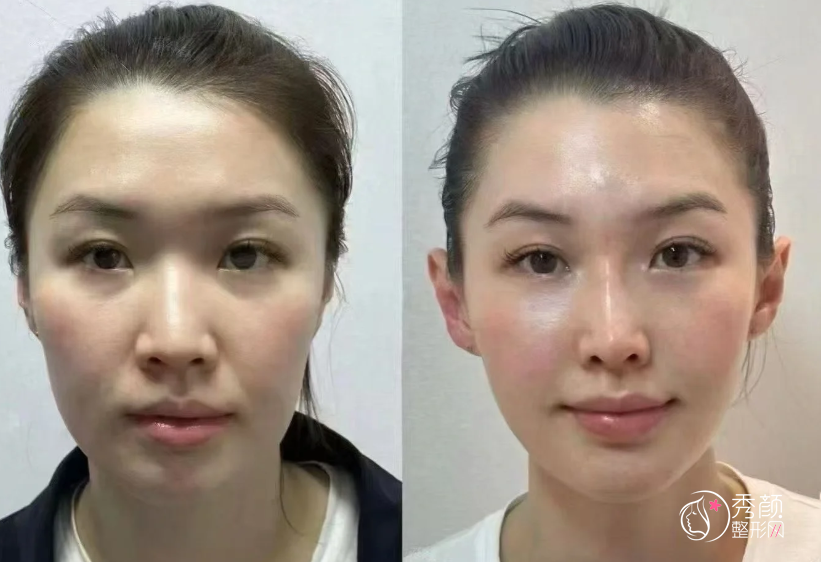 青岛自体脂肪丰面颊医生排名：王开宇、孙好杰、赵煜楠等医生实力上榜