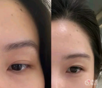 长沙自体脂肪丰面颊医生排名：靳海涛、明经发、周文亮等医生实力上