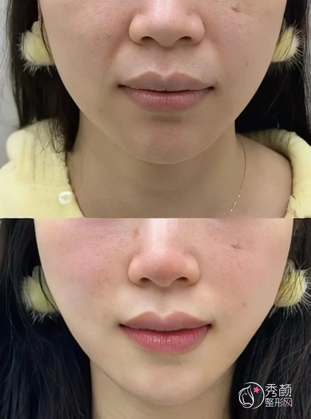 重庆自体脂肪丰面颊医生排名：郑荃、赵亚均、吴继东等医生实力上榜