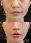 深圳自体脂肪丰面颊医生排名：卢颖、郭杰、唐新辉等医生实力上榜